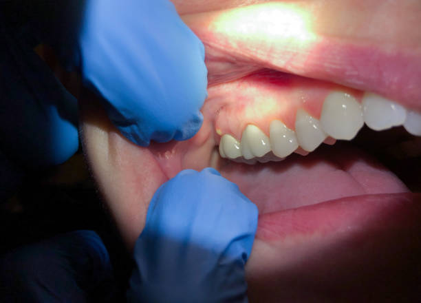 Best Emergency Tooth Extraction  in Oak Hill, OH